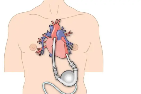 Schemat przedstawia serce z wszczepioną pompą wspomagającą krążenie, ilustrując cykl hemodynamiczny serca.