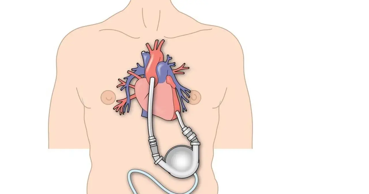 Schemat przedstawia serce z wszczepioną pompą wspomagającą krążenie, ilustrując cykl hemodynamiczny serca.