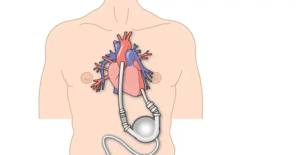 Schemat przedstawia serce z wszczepioną pompą wspomagającą krążenie, ilustrując cykl hemodynamiczny serca.